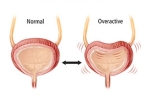 Overactive Bladder prevention, Overactive Bladder news, here are some warning signs of an overactive bladder, Overactive bladder