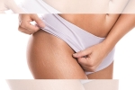 stretch marks causes, stretch marks causes, difference between red and white stretch marks explained and it s natural to have them, Stretch marks