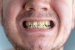 Nicotine stains research, Nicotine stains latest, are nicotine stains on your teeth irreversible, Bad breath