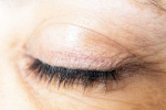 Eyelash Dandruff latest, Eyelash Dandruff breaking, all about eyelash dandruff, Inflammatory diseases