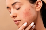 skin, dermatologist, 10 ways to get rid of pimples at home, Natural glow